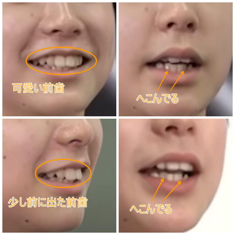 ユウキの歯並びの画像