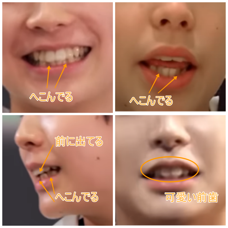 ユウキの歯並びの画像