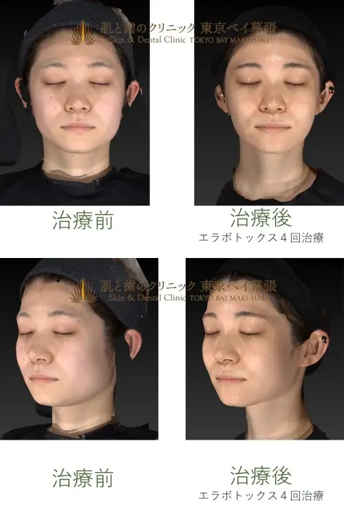 エラボトックスの画像